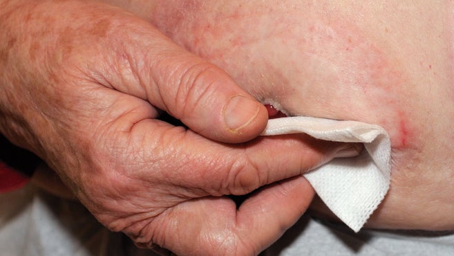 Hand, die das Stoma reinigt