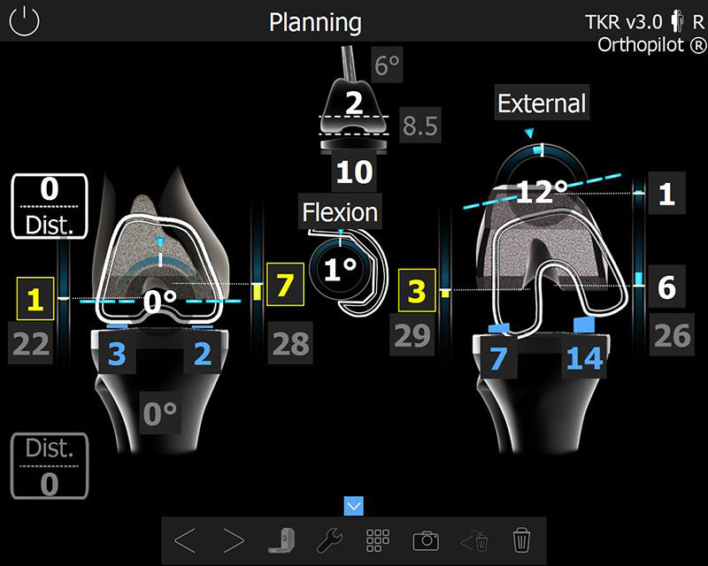 Screenshot der OrthoPilot® TKR Software – Femurschnitt- und Augmentationsplanung