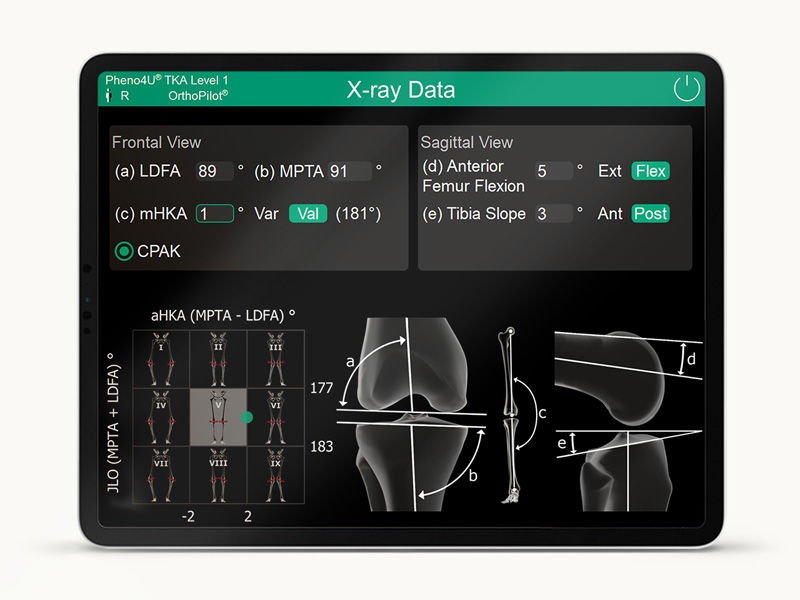 OrthoPilot Elite Bildschirm mit Röntgendaten und CPAK-Klassifizierung.