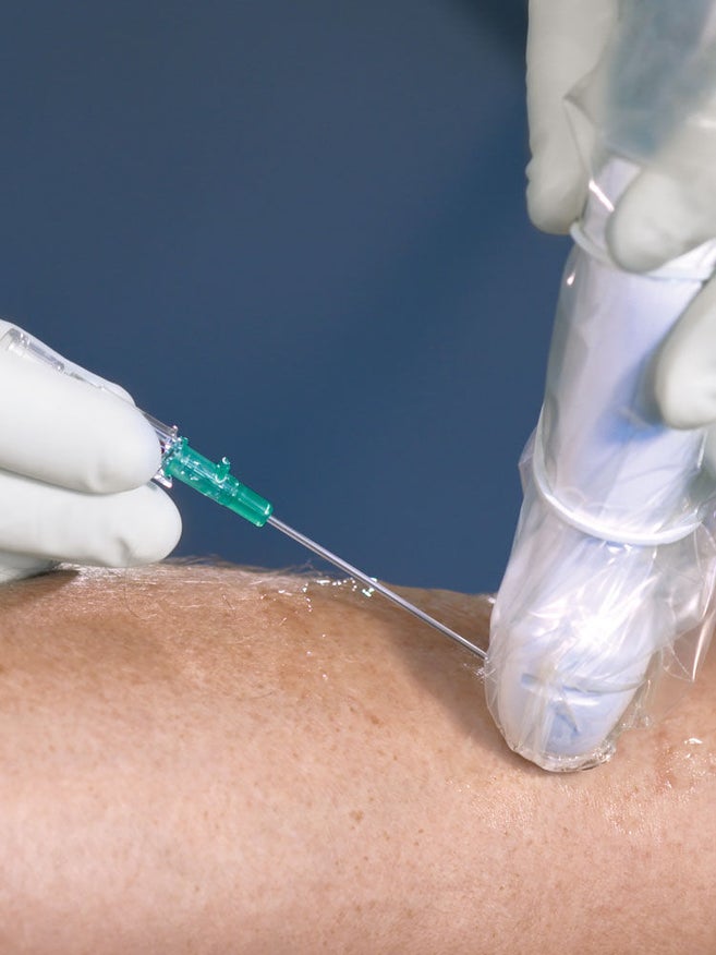 Hand mit weißem Handschuh hält grüne Kanüle mit transparentem Gel am Arm. Die andere Hand mit weißem Handschuh hält die Ultraschallsonde mit transparenter Schutzhülle, die mit einem weißen Gummiring befestigt ist.