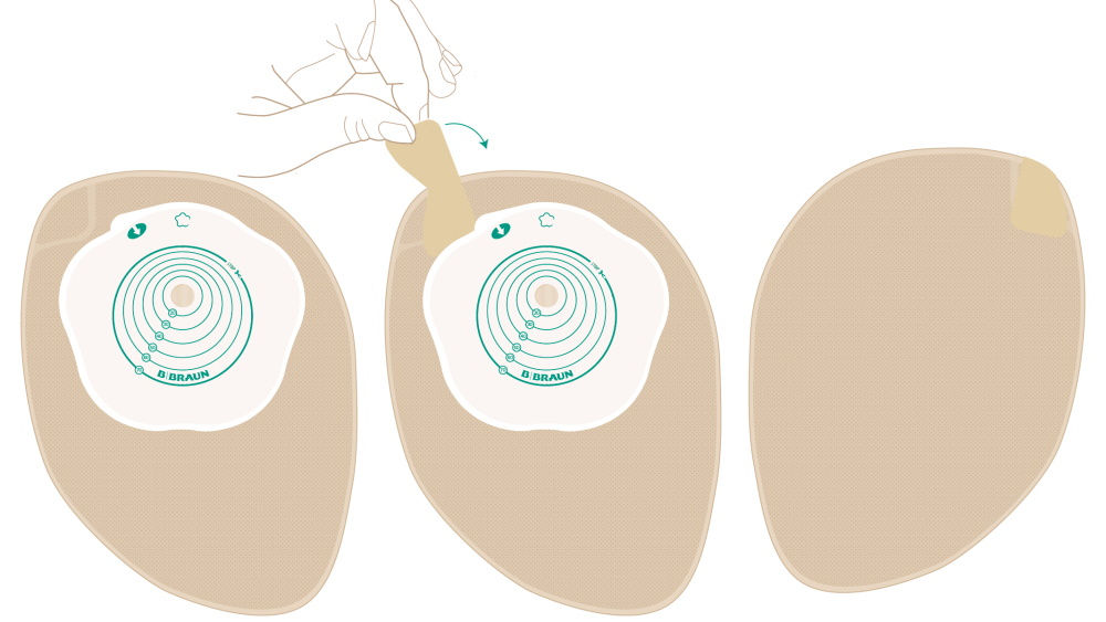 Stomabeutel mit Eckfilter am oberen Rand