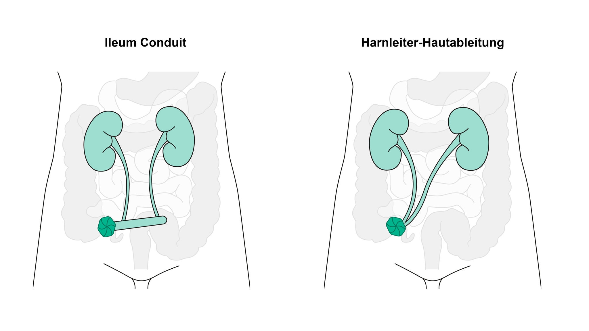 Ilealkanal und Ureterostomie-Abbildung