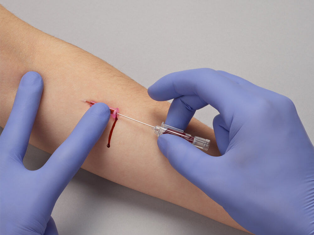 Blutaustritt während der Blutentnahme