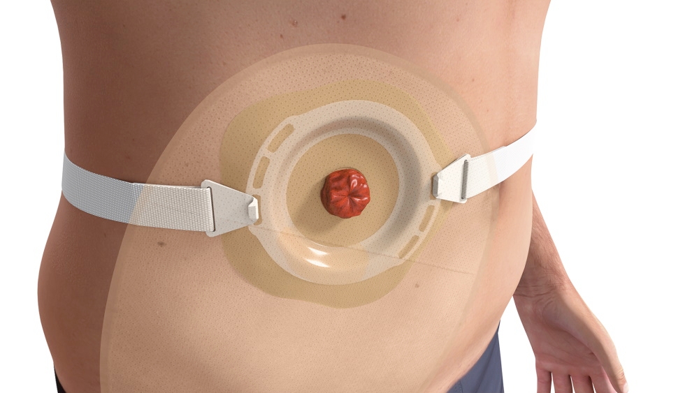 Stoma Inversion Konvexe Stomaversorgung gegen Stomaleckage - B. Braun