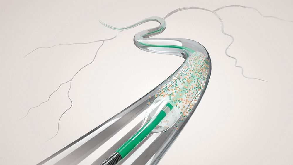 Ein koronaler medikamentenbeschichteter Ballon, der bei der Angioplastie einer verkalkten koronaren Arterienläsion verwendet wird.
