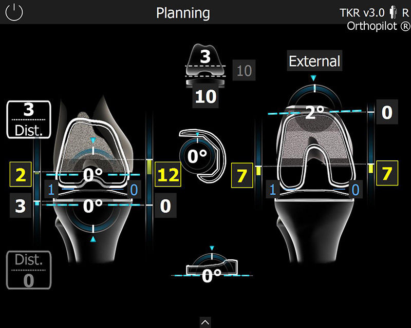 Screenshot der OrthoPilot® TKR Software – Planung