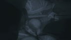 Aneurysm ICG Fluorescence