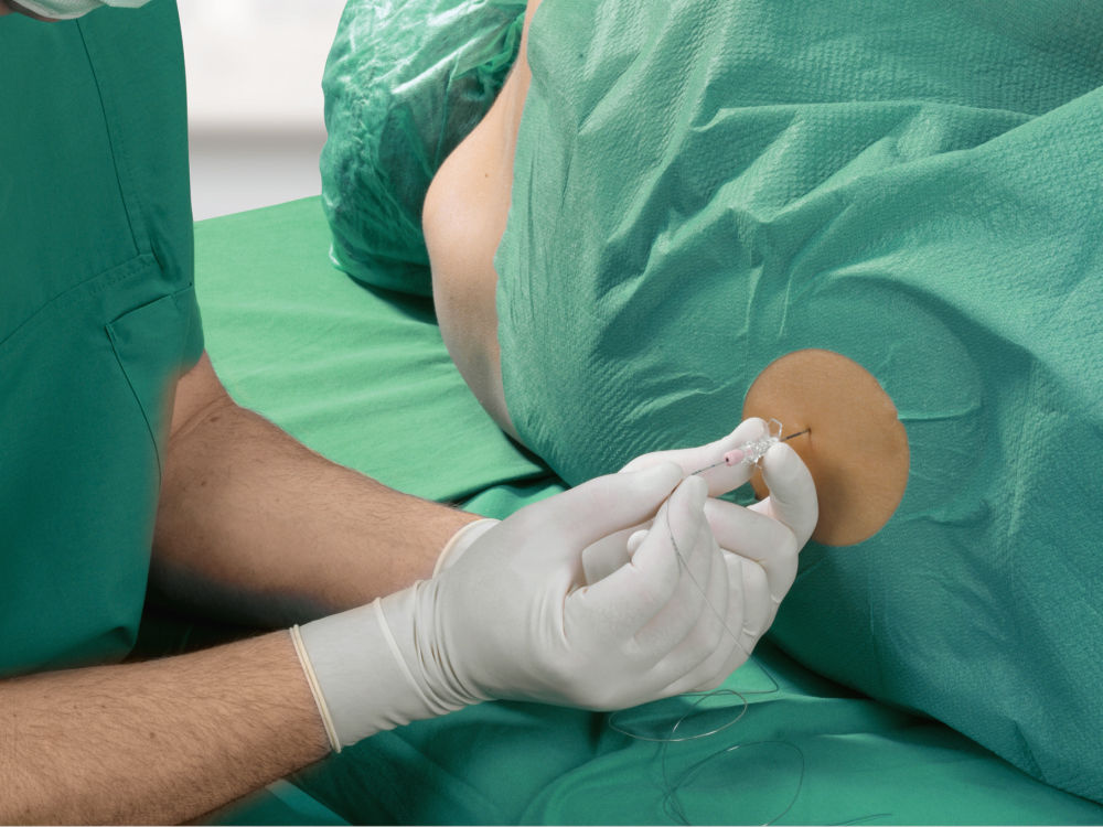 Punktion der Wirbelsäulenhöhle im Rahmen einer Regionalanästhesie – der Anästhesist trägt grüne OP-Kleidung und Handschuhe, der Patient liegt auf einem grünen Abdecktuch und trägt eine OP-Mütze