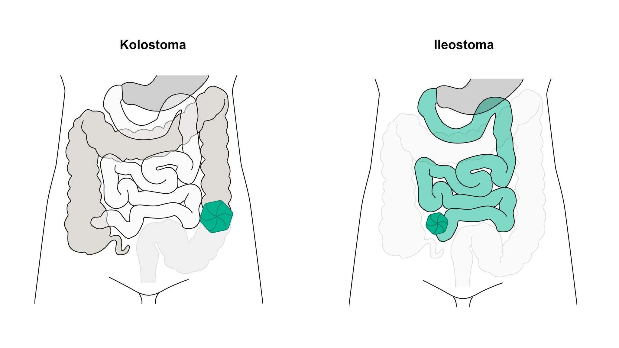 Abbildung Kolostoma und Ileostoma