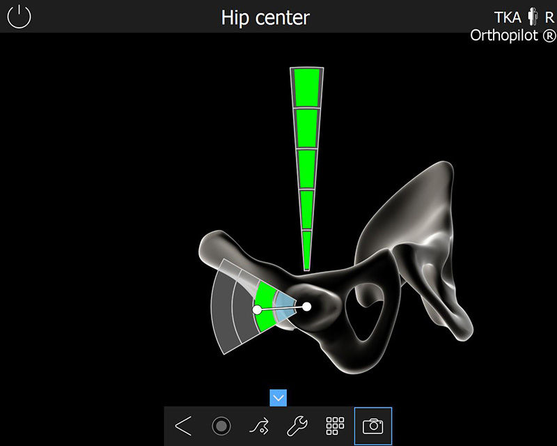 Screenshot der OrthoPilot® TKA Software – Hüftgelenkzentrum