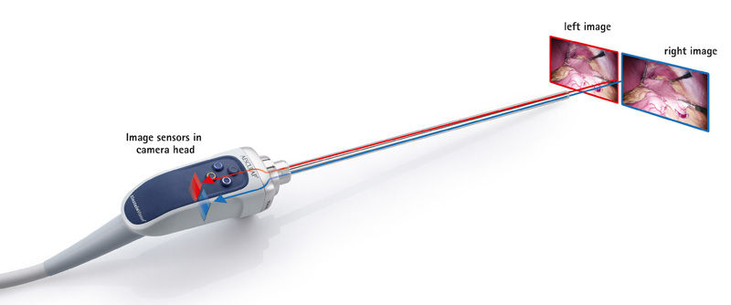 Beispiel für konventionelle 3D-Kamerasysteme wie das EinsteinVision® 3D-System