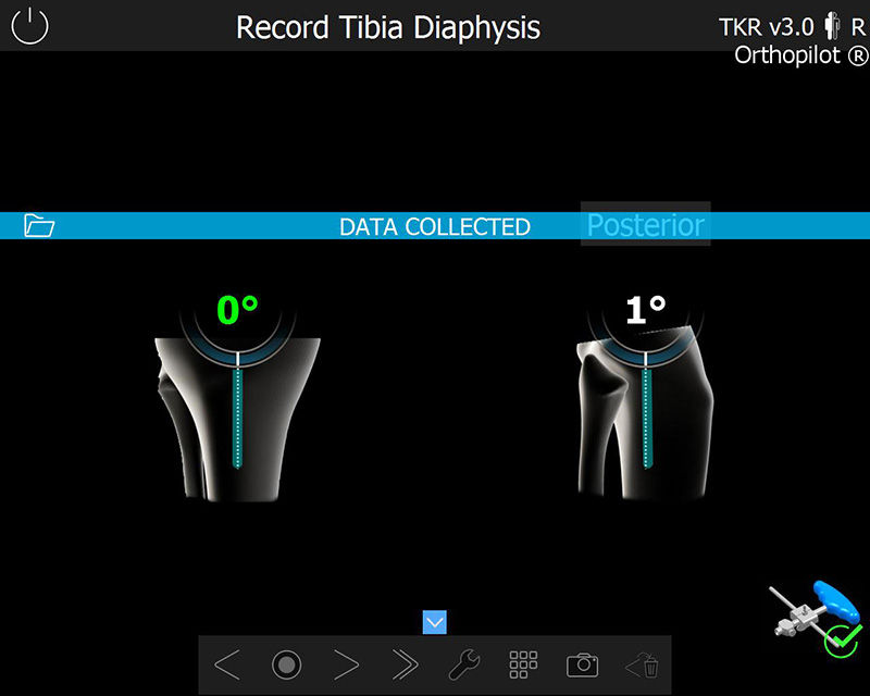 Screenshot der OrthoPilot® TKR Software – Erfassung der Tibiadiaphyse