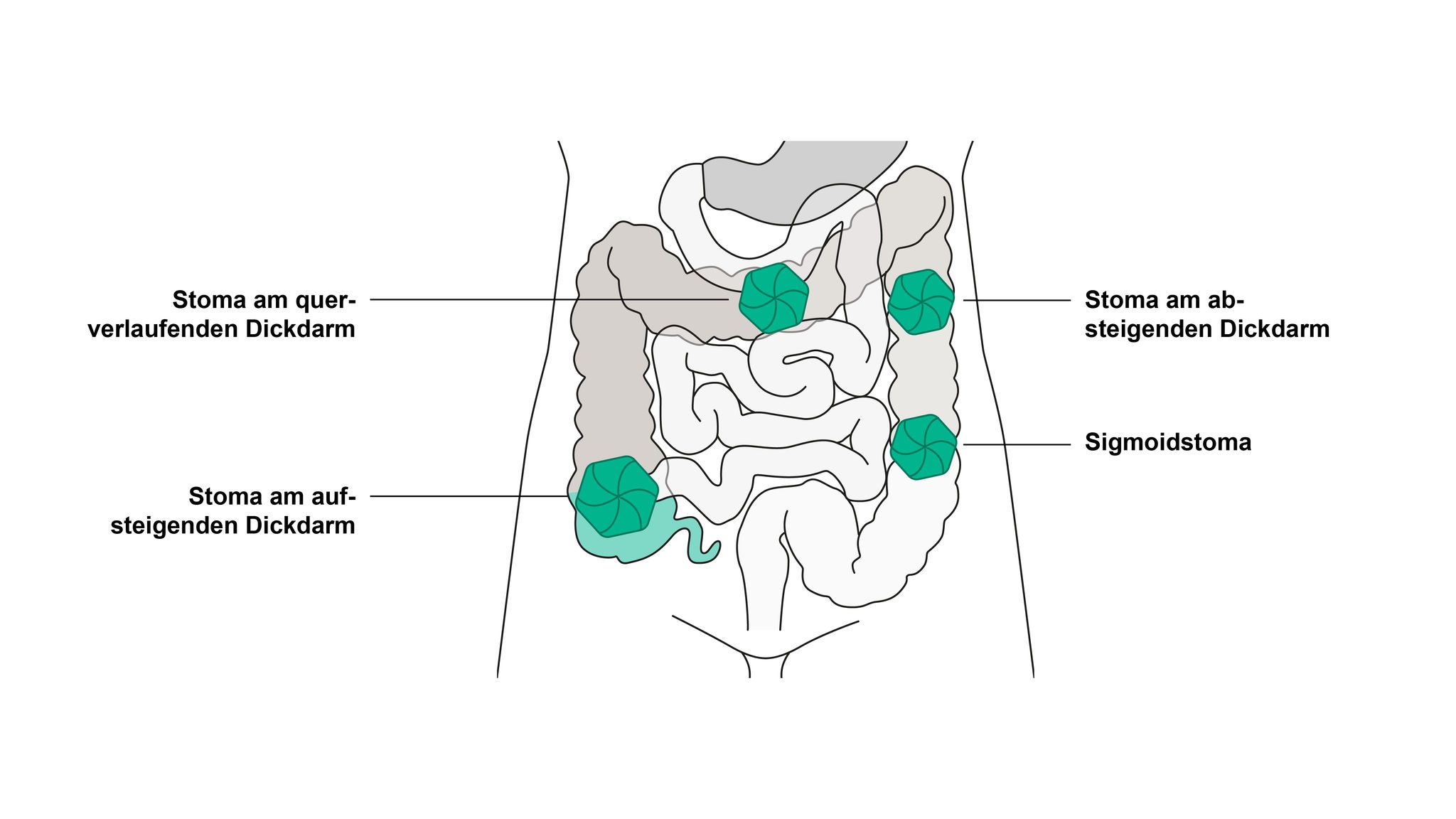 Abbildung einer Quer-, Abwärts-, Aufwärts- und Sigmakolostomie