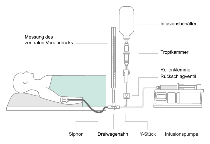 Scheme of a parallel infusion configuration. Combinations of gravity infusion and pump driven infusion in parallel bears the risk of air embolism, when gravity infusion runs dry.