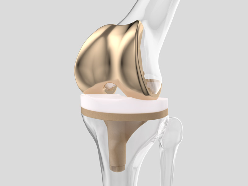 Innovative Mehrschichtbeschichtung auf einem Knieknochenimplantat zur Verbesserung der Biokompatibilität