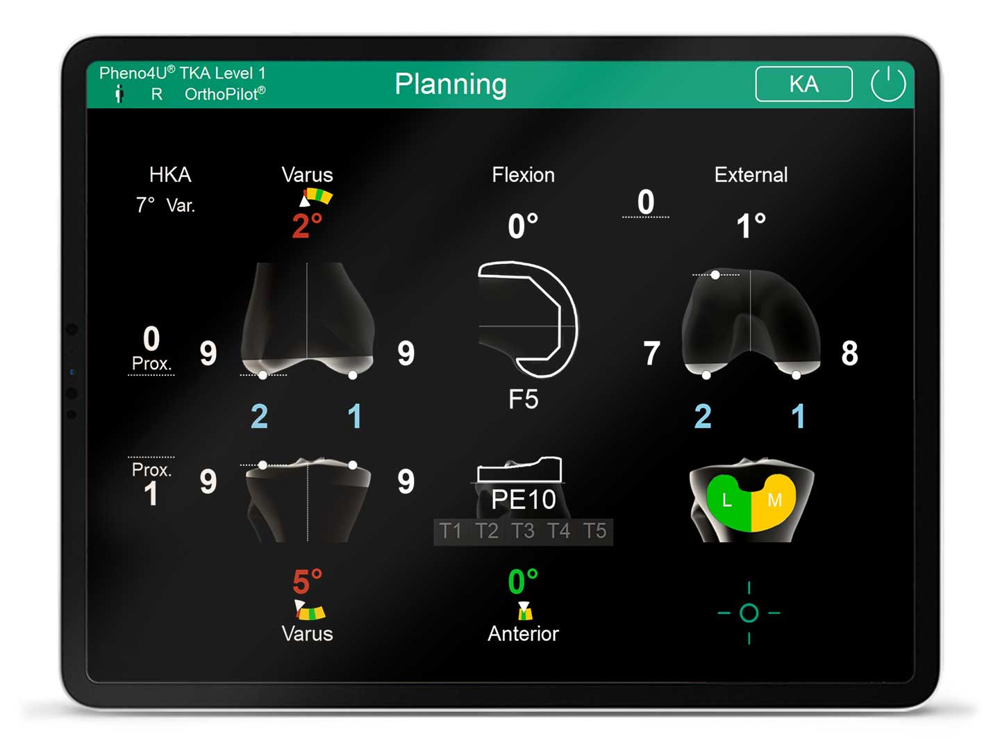 Bildschirm der OrthoPilot Elite Navigationssoftware Pheno4U TKA Level 1