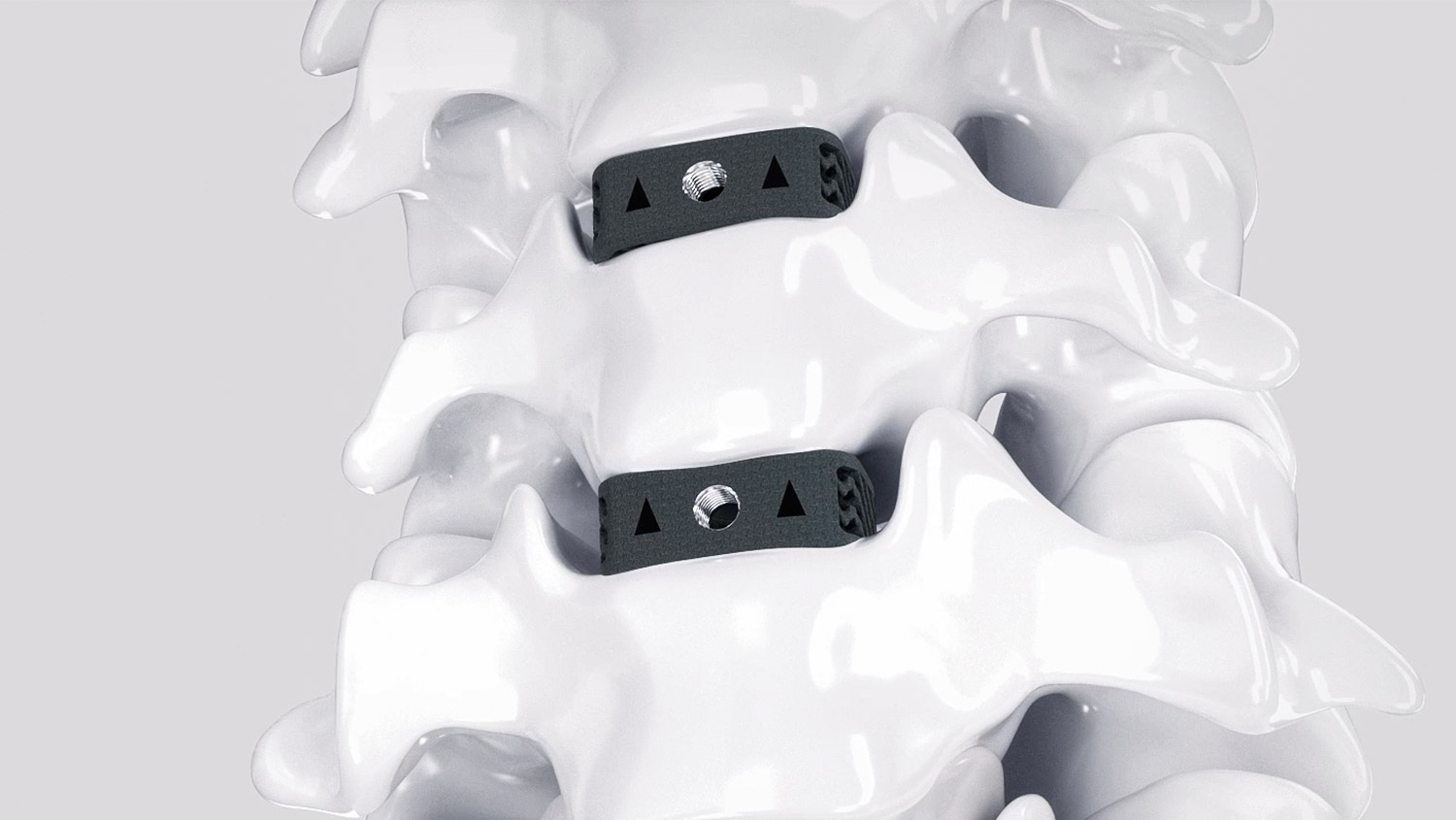 3D-gedruckte zervikale Wirbelkörperfusionsgeräte